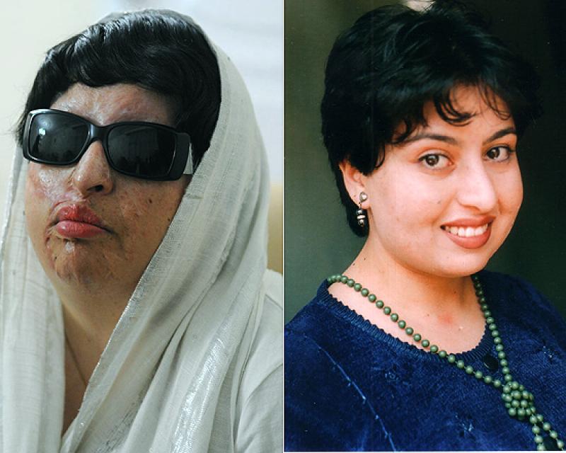 Jovem Iraniana que teve rosto deformado ganhou na justiça o direito de cegar o agressor