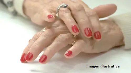 Homem é preso após atear fogo na companheira por causa de unhas pintadas de vermelho