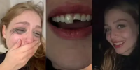 Jovem quebra dente em festa, vai ao dentista de madrugada e volta à balada